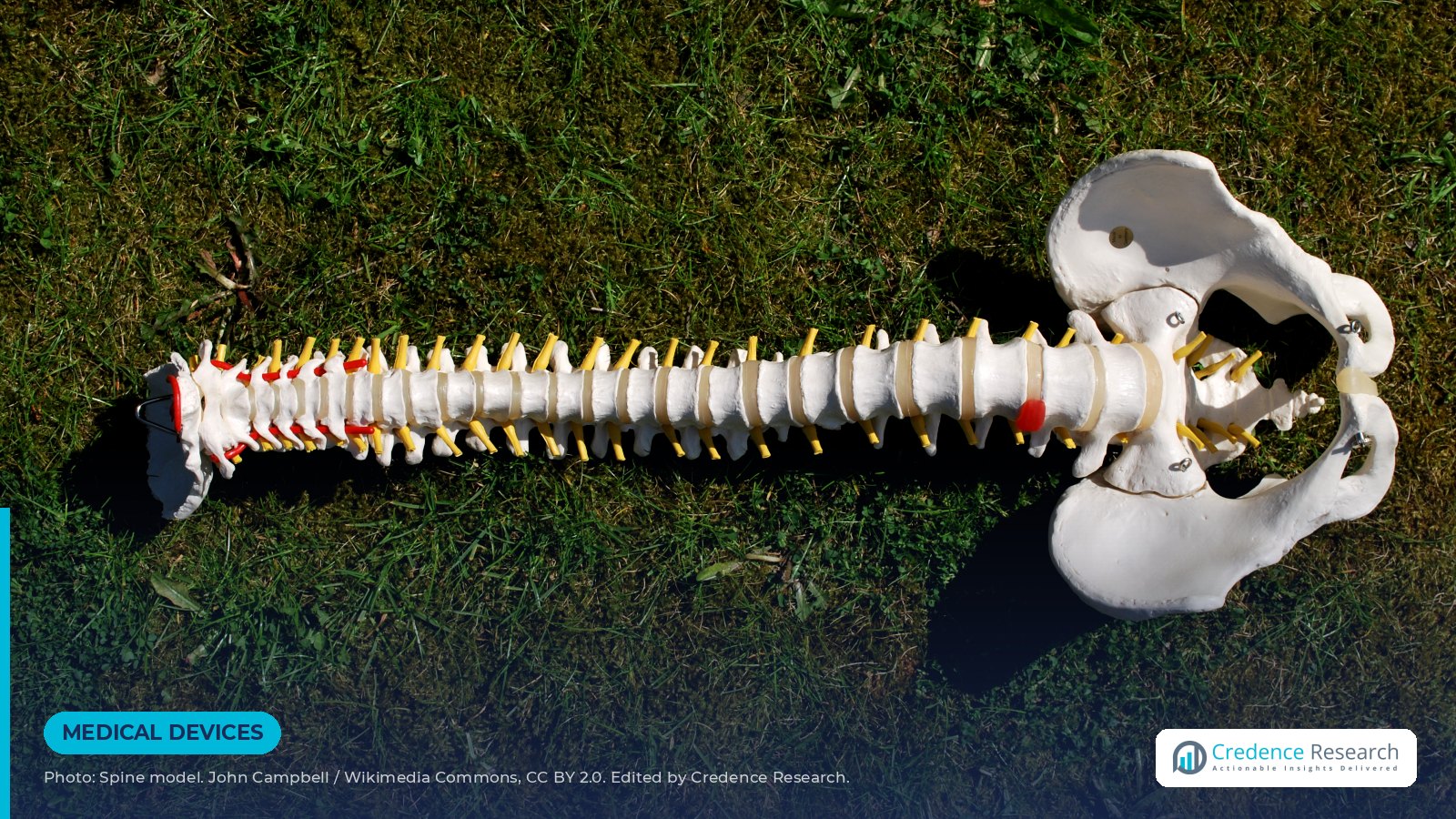 Spinal Stimulator Recalls: Key Information for Device Patients