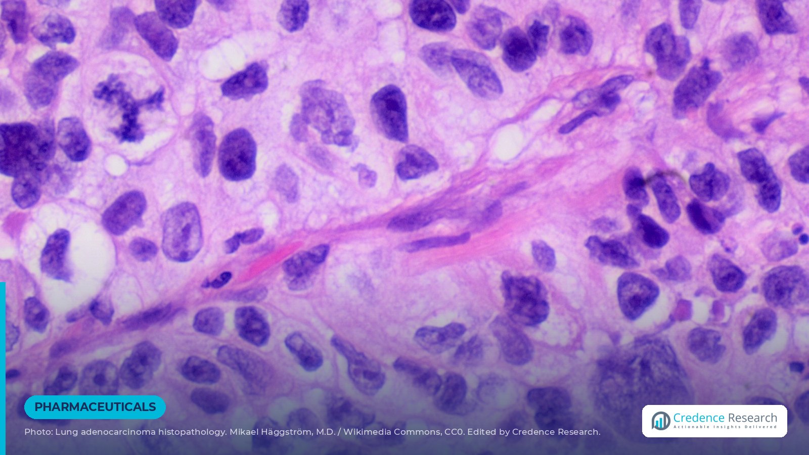 Kelun's Sac-TMT Plus Keytruda Cuts Progression Risk 51% in PD-L1-Negative First-Line Lung Cancer